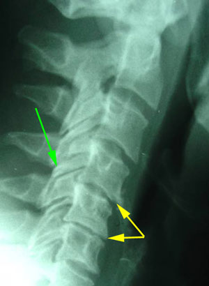 disc degeneration treated at Young Chiropractic
