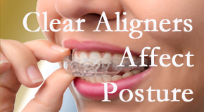 Clear aligners influence posture which Easley chiropractic helps.