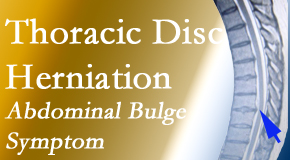 Young Chiropractic treats thoracic disc herniation that for some patients prompts abdominal pain.