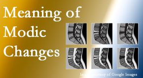 Young Chiropractic sees many back pain and neck pain patients who bring their MRIs with them to the office. Modic changes are often noted. 