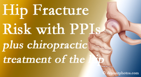 Young Chiropractic shares new research describing increased risk of hip fracture with proton pump inhibitor use. 
