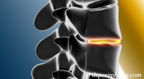 Easley degenerative spinal changes 