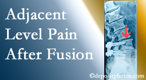 Young Chiropractic offers relieving care non-surgically to back pain patients suffering with adjacent level pain after spinal fusion surgery.