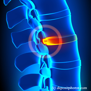 picture of lumbar Easley disc herniation